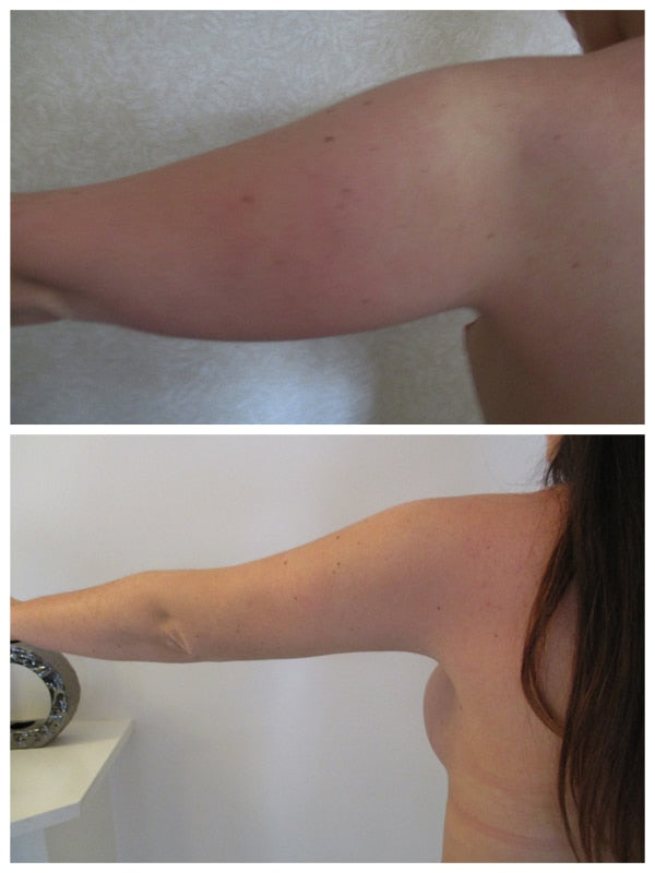 cl:liposuccion-bras-eviter-lifting-bras.jpg