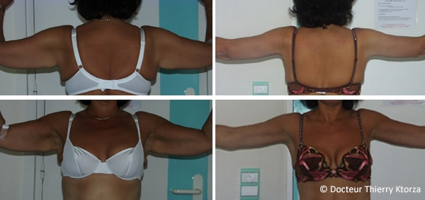 cl:photo-avant-apres-lifting-bras-perte-de-poids.jpg